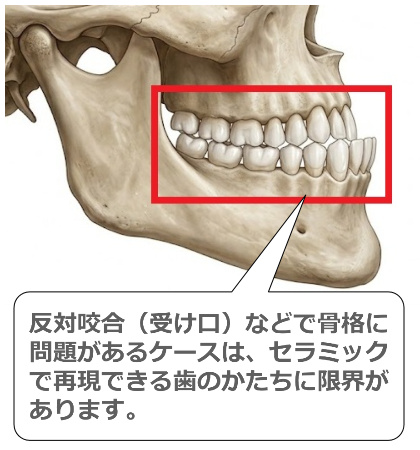 受け口の骨格