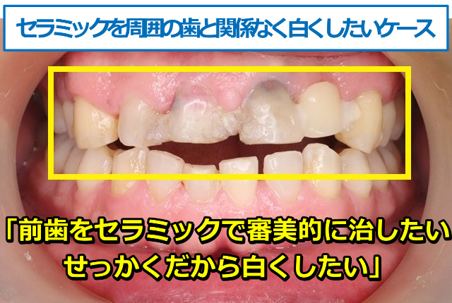 前歯をセラミックで審美的に治したい。せっかくだから白くしたい
