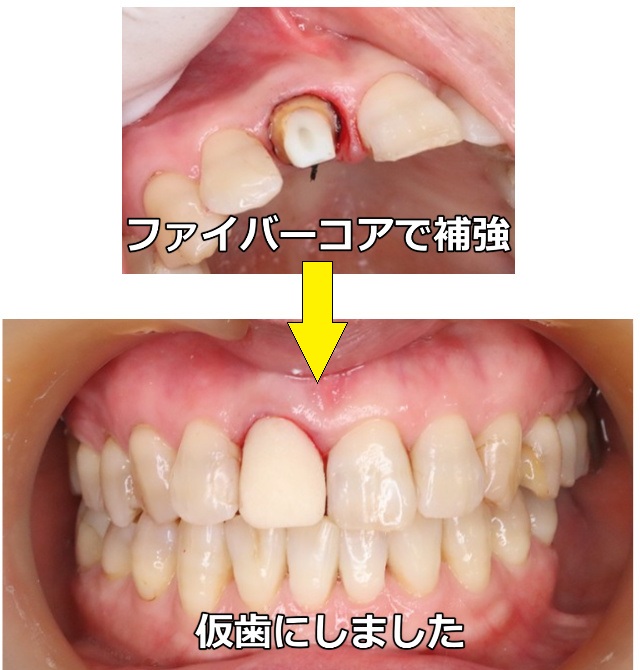 ファイバーコアで補強⇒仮歯へ