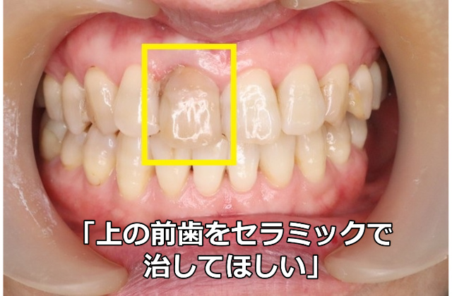 変色している前歯