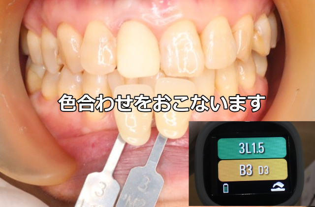 セラミックの色合わせをしているところ