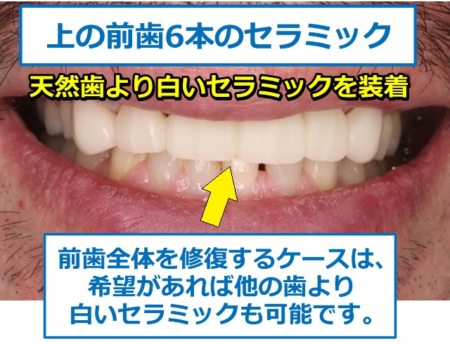 天然歯より白いセラミックを装着
