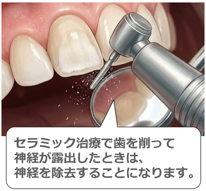 歯を削っているところ