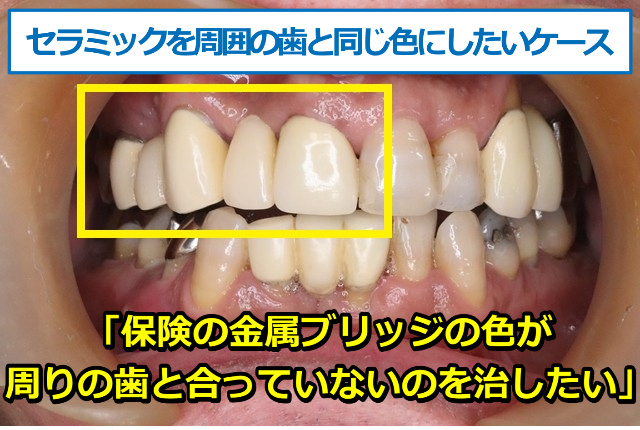保険の金属ブリッジ