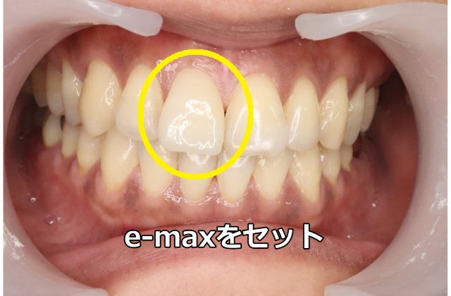 e-maxをセット