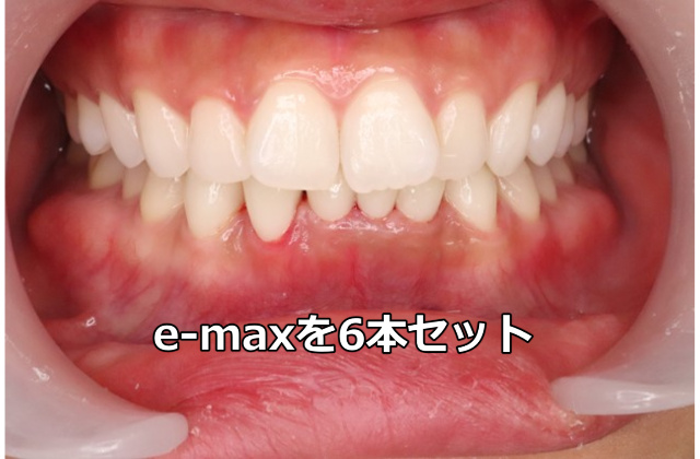 e-maxを6本セット