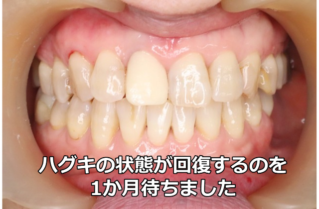 ハグキが回復するのを1か月待機