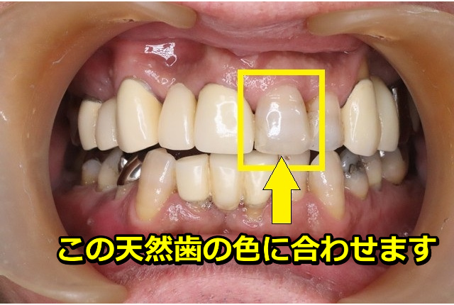 左上前歯に色を合わせます
