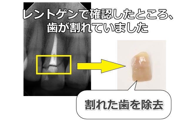 割れた歯を除去