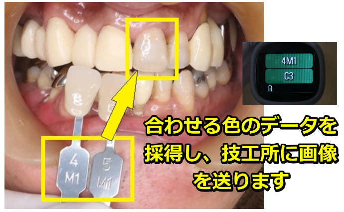 合わせる色のデータを採得し、技工所に画像を送ります
