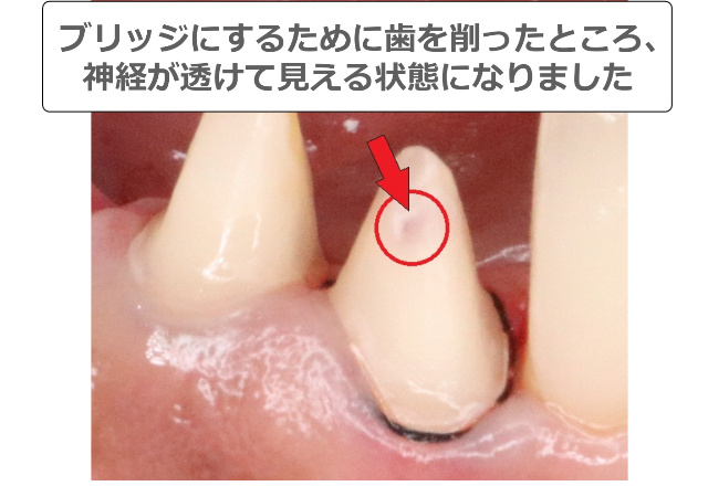形成してピンクスポットが出ている歯