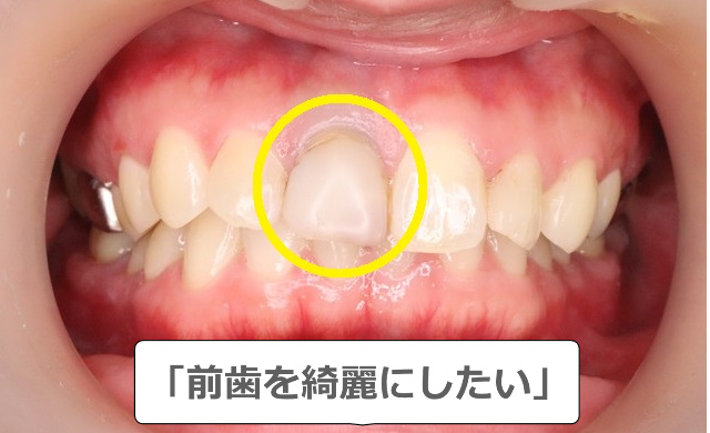 「前歯を綺麗にしたい」