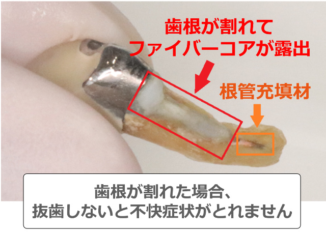 歯根破折してファイバーコアが露出した歯