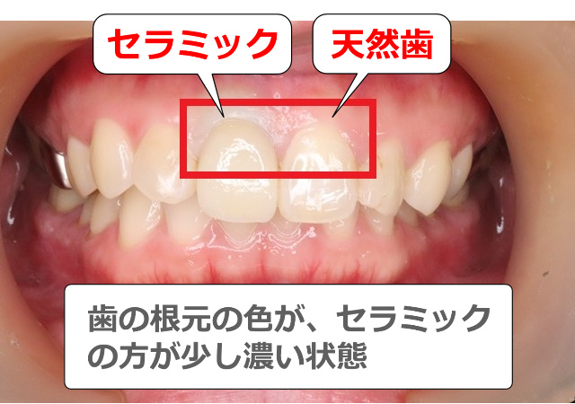 セラミックの方が根元の色が濃い