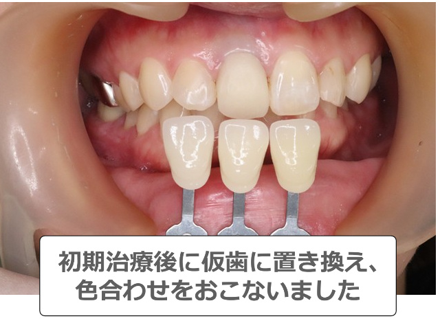 仮歯への置き換え