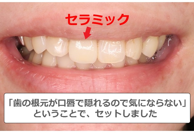 セラミックをセット