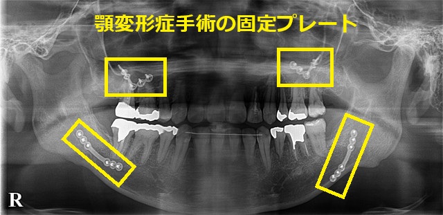 顎変形症手術の固定プレート