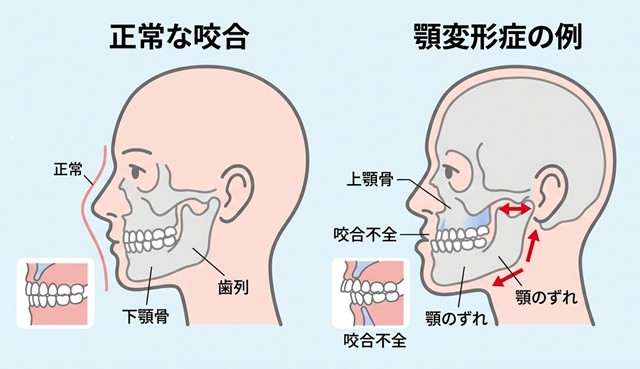 顎変形症のイメージ図
